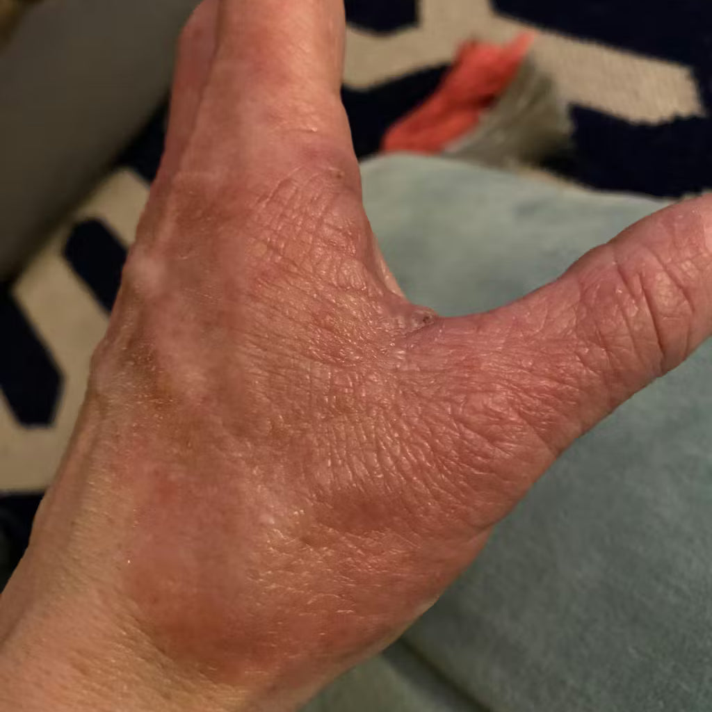 Adult sensitive skin before applying Matylda Baby balm, showing dry irritated patches